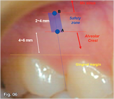 오솔루션 Precautions according to insertion site: Maxilla